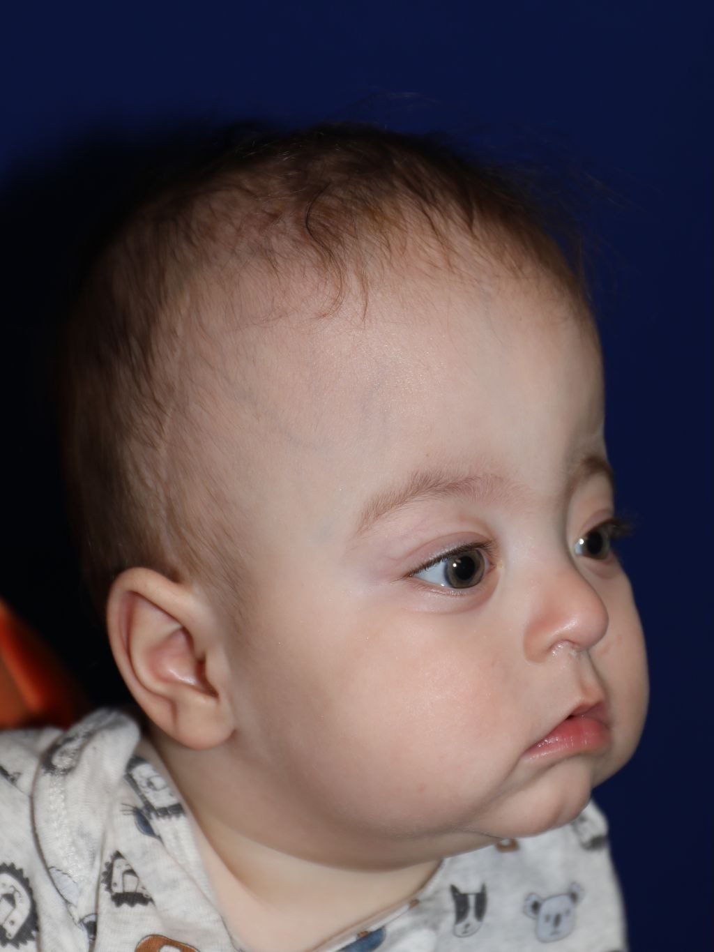 Right angle before treatment - Case 1001
