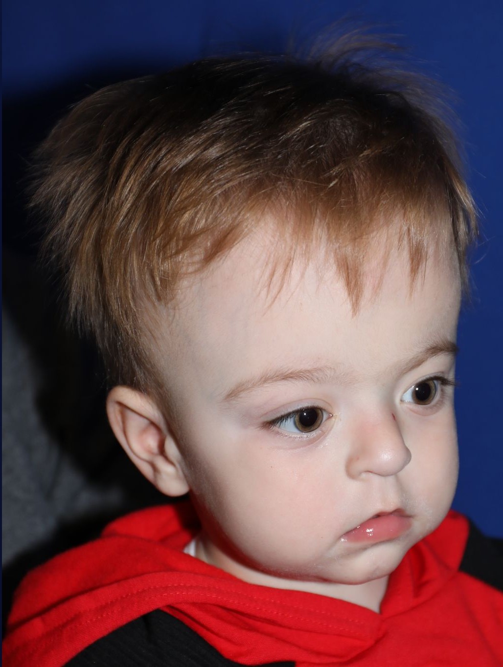 Right angle at Year 2 after treatment - Case 1001