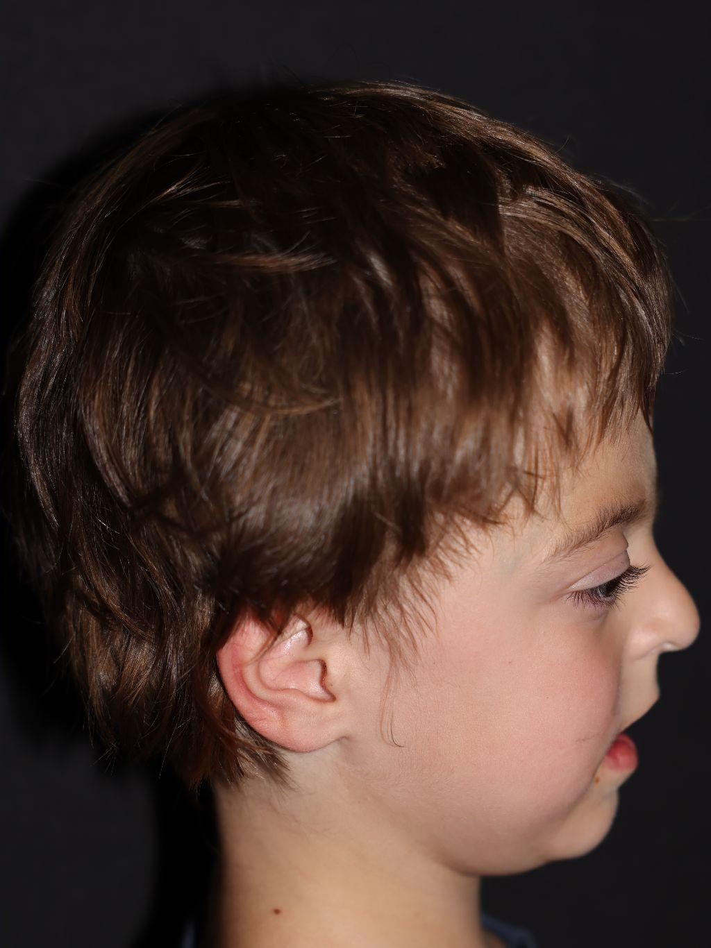 Right profile at Year 3 after treatment - Case 1001
