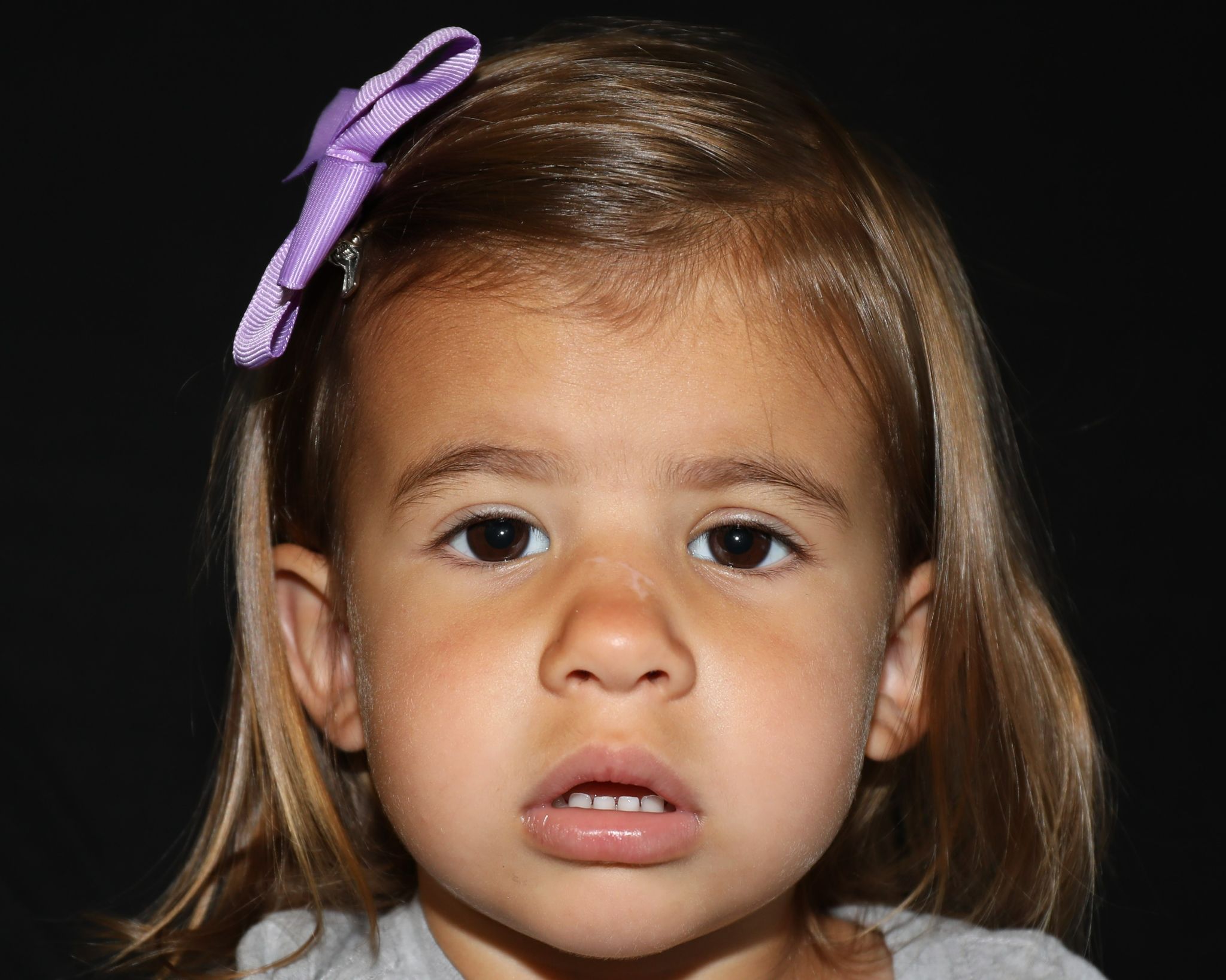 Front view at Year 3 after treatment - Case 1008