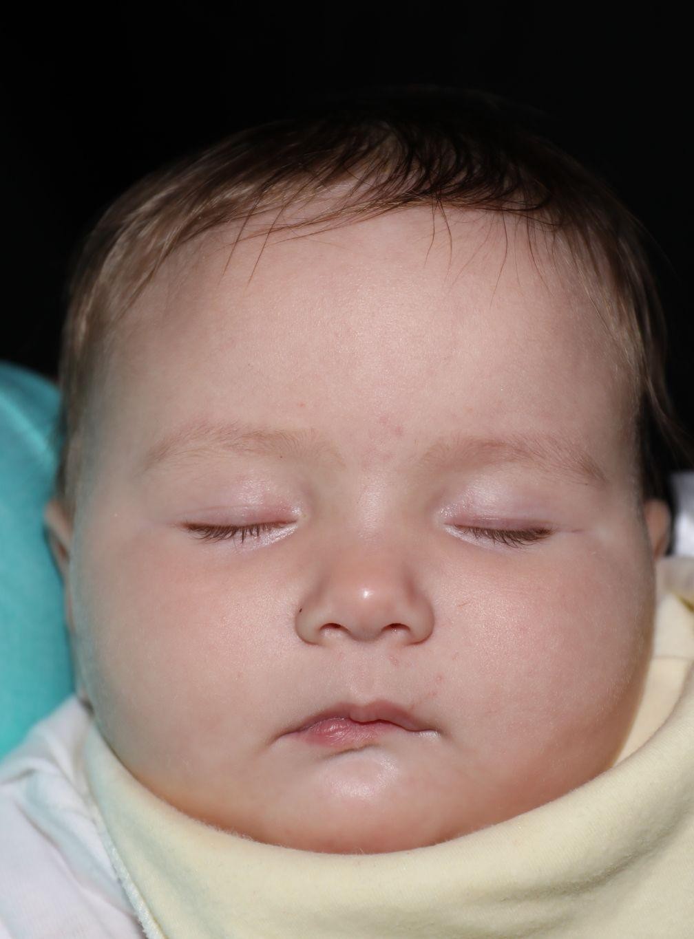 Front view before treatment - Case 1017
