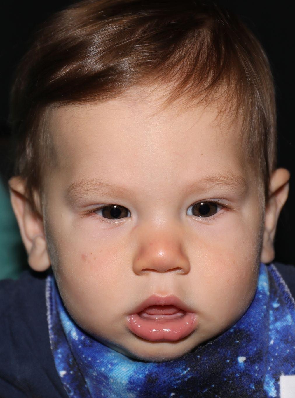 Front view before treatment - Case 1013