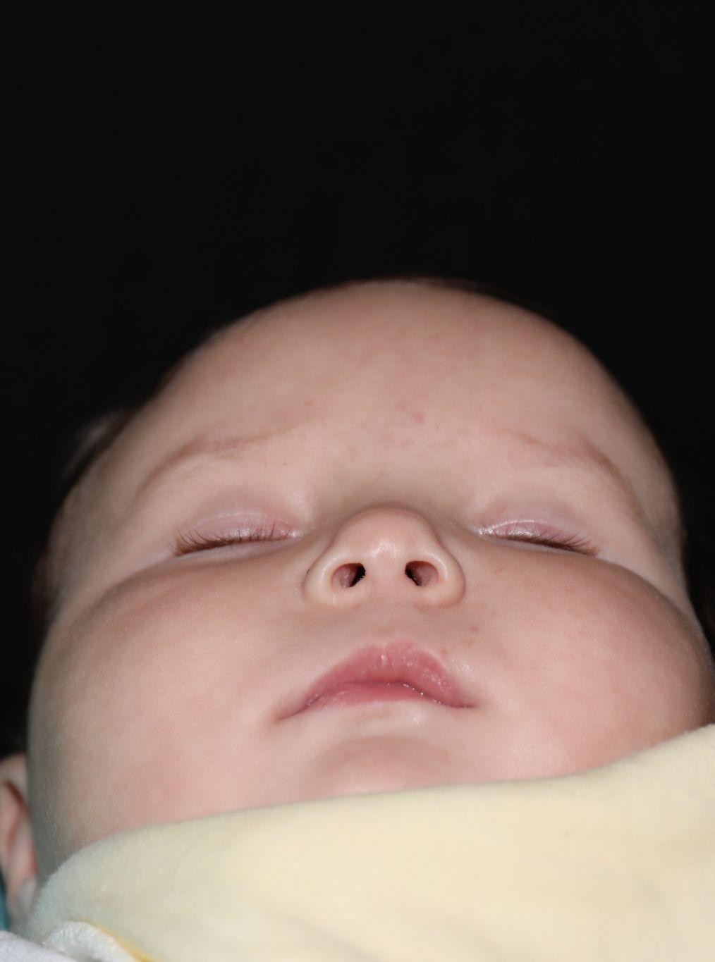Chin before treatment - Case 1017