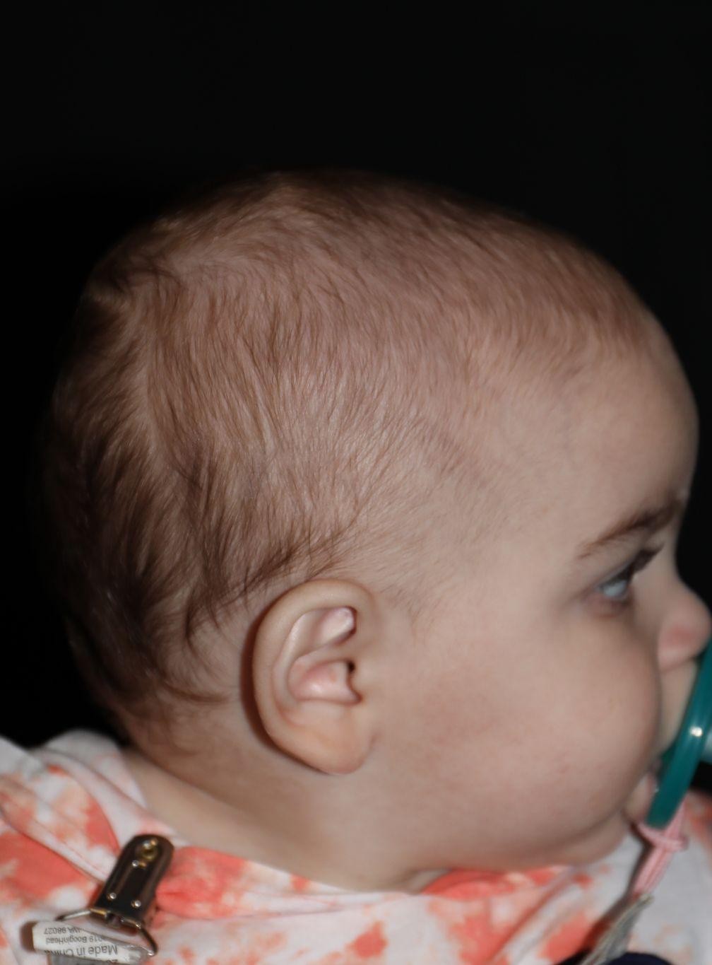 Right profile before treatment - Case 1016