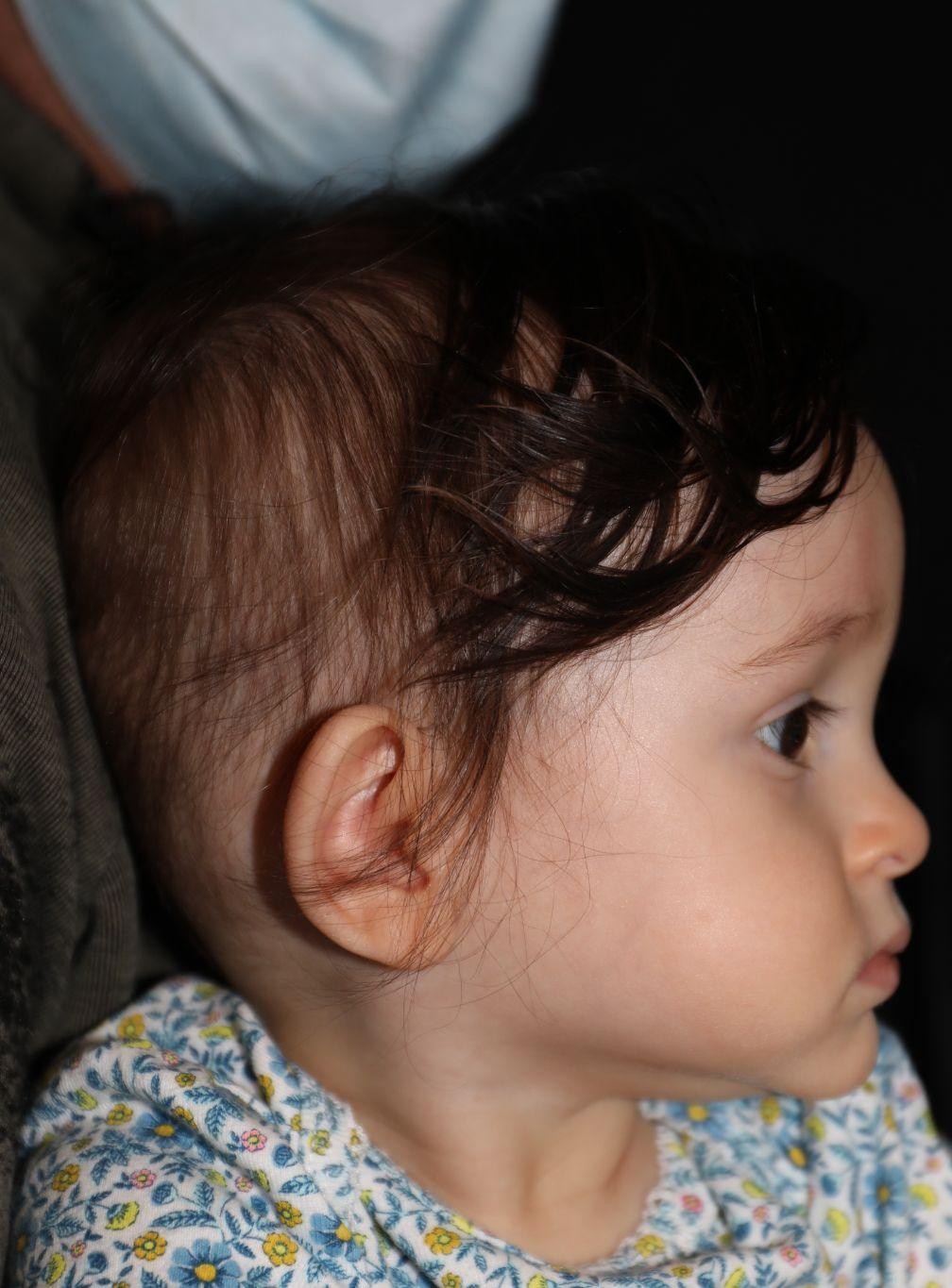 Right profile before treatment - Case 1020
