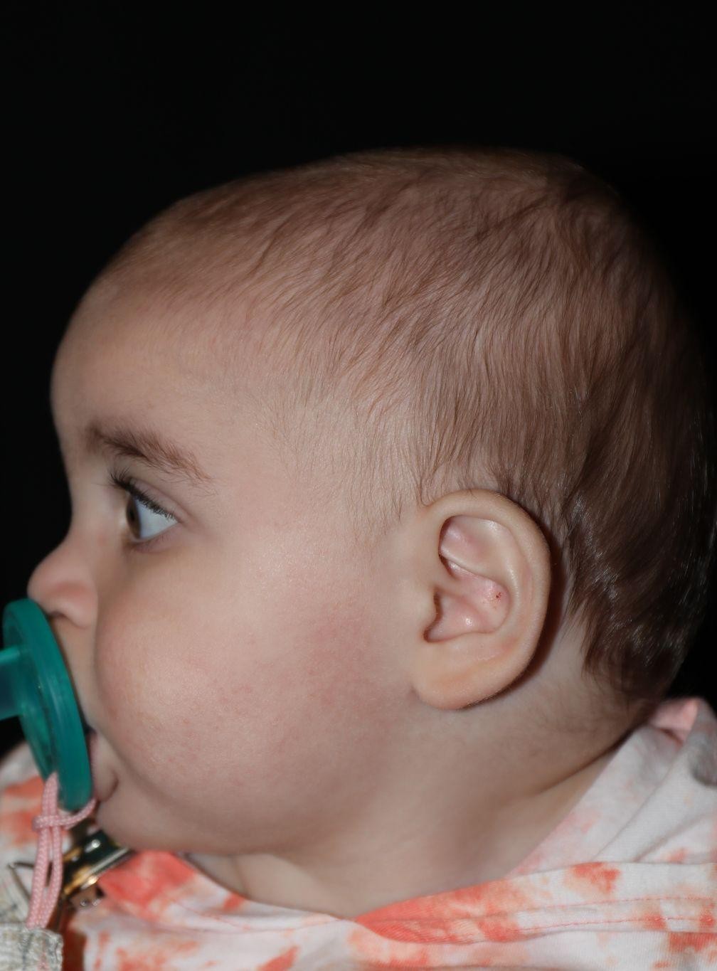 Left profile before treatment - Case 1016