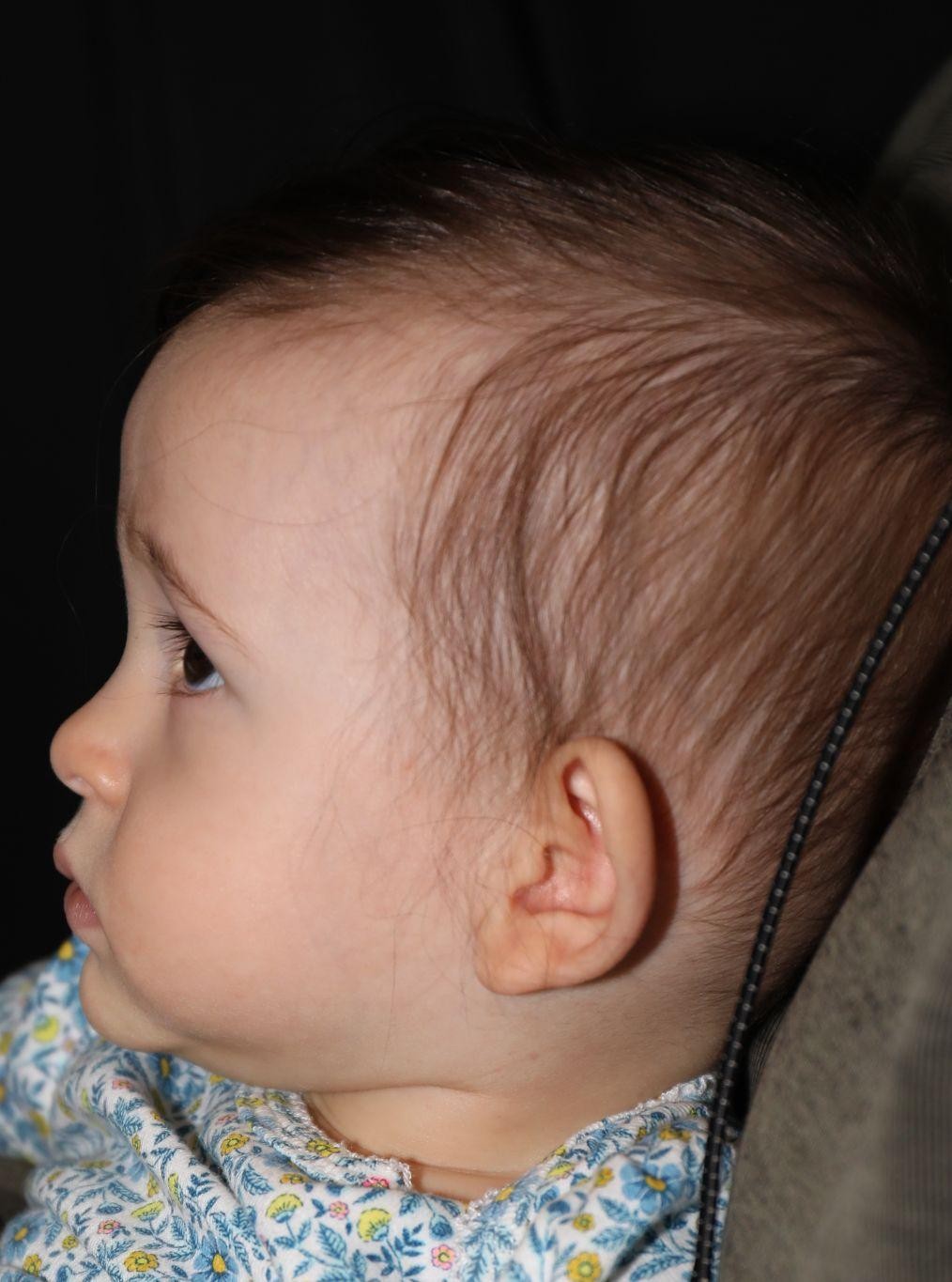 Left profile before treatment - Case 1020