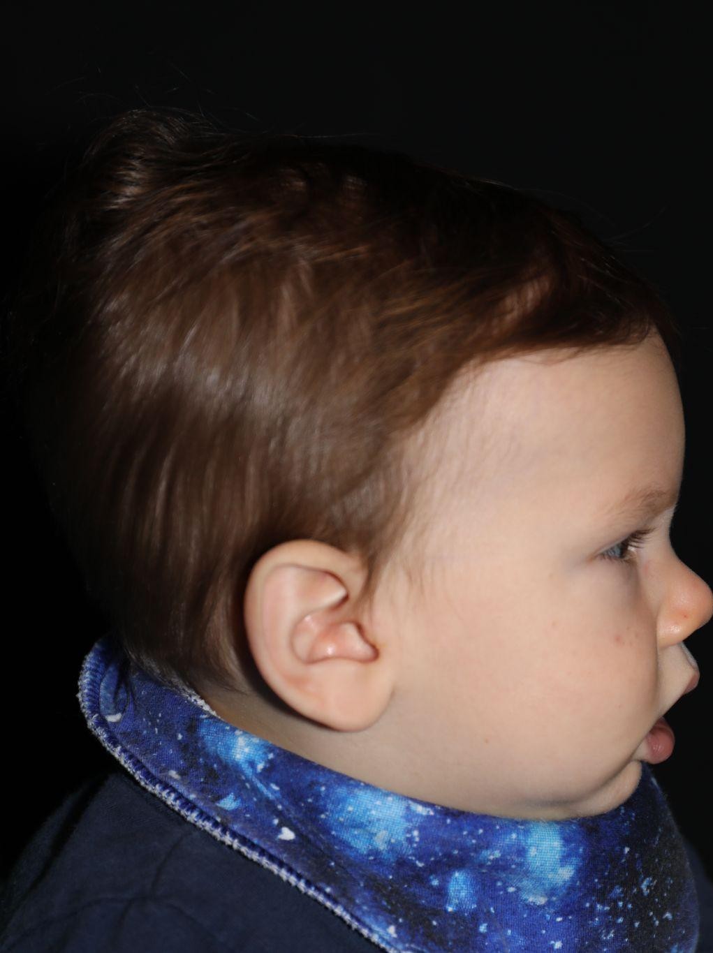 Right profile before treatment - Case 1013