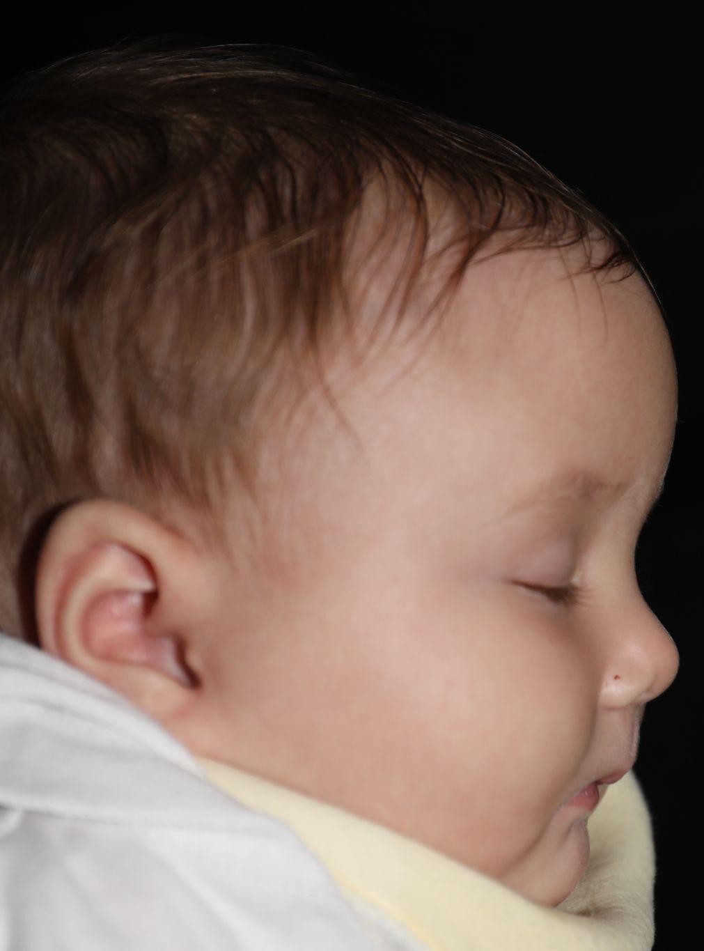 Right profile before treatment - Case 1017