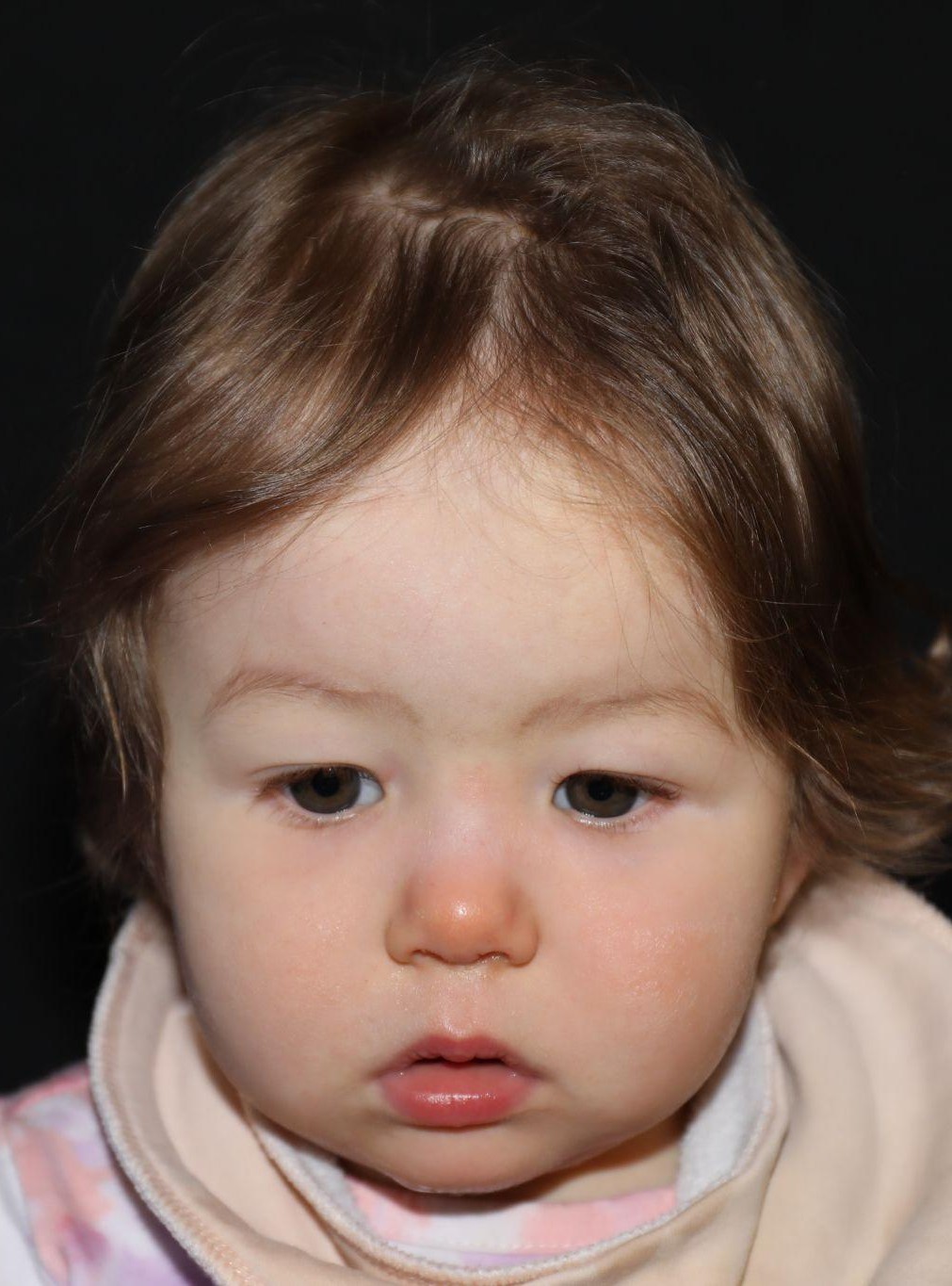 Front view at Year 2 after treatment - Case 1017