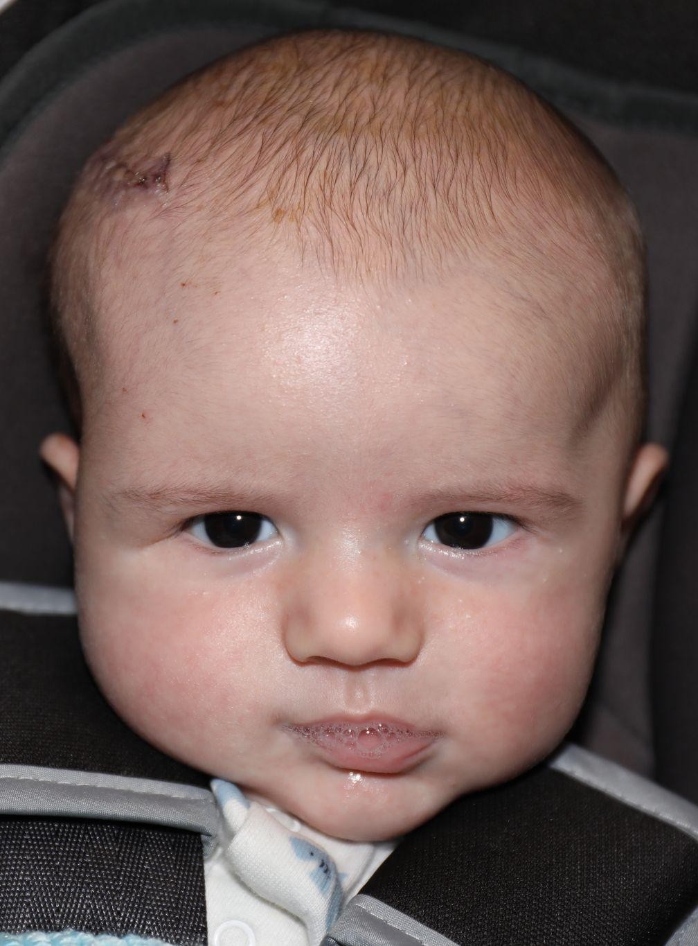 Front view at Year 2 after treatment - Case 5002