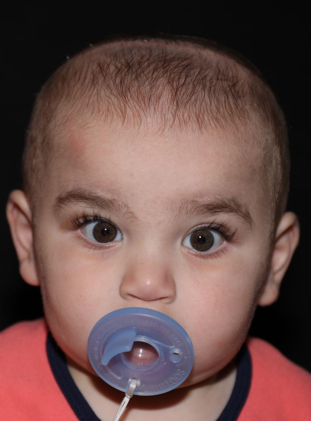 Front view at Year 2 after treatment - Case 1016