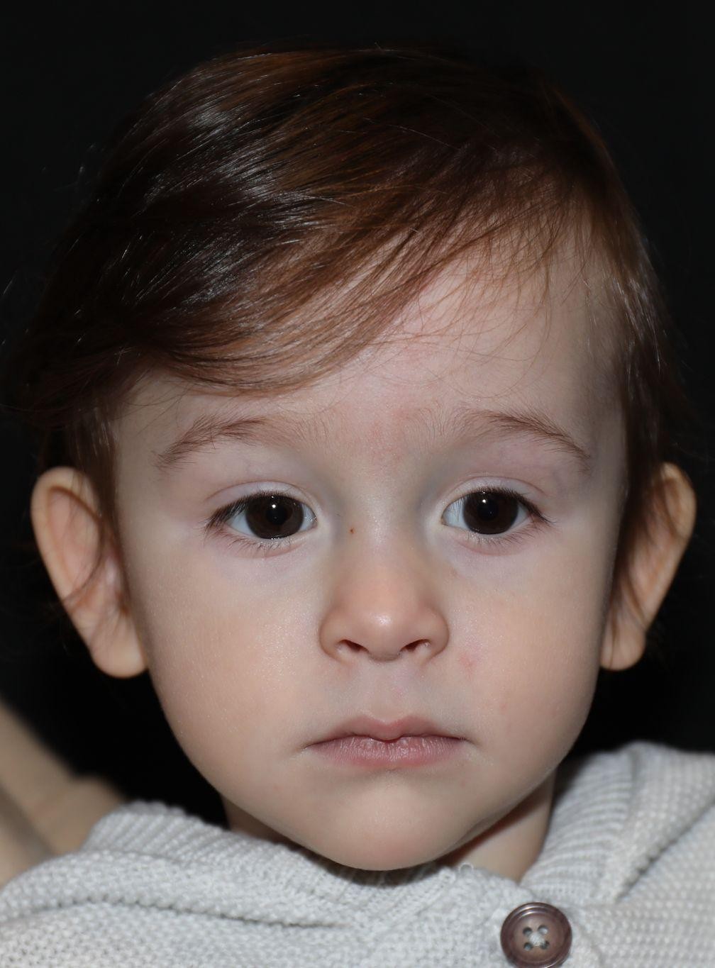 Front view at Year 2 after treatment - Case 1020