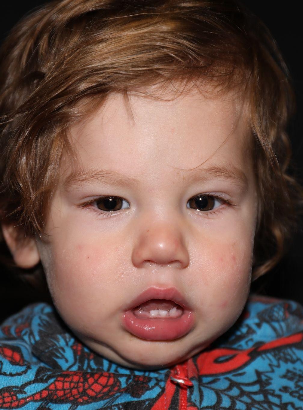 Front view at Year 2 after treatment - Case 1013