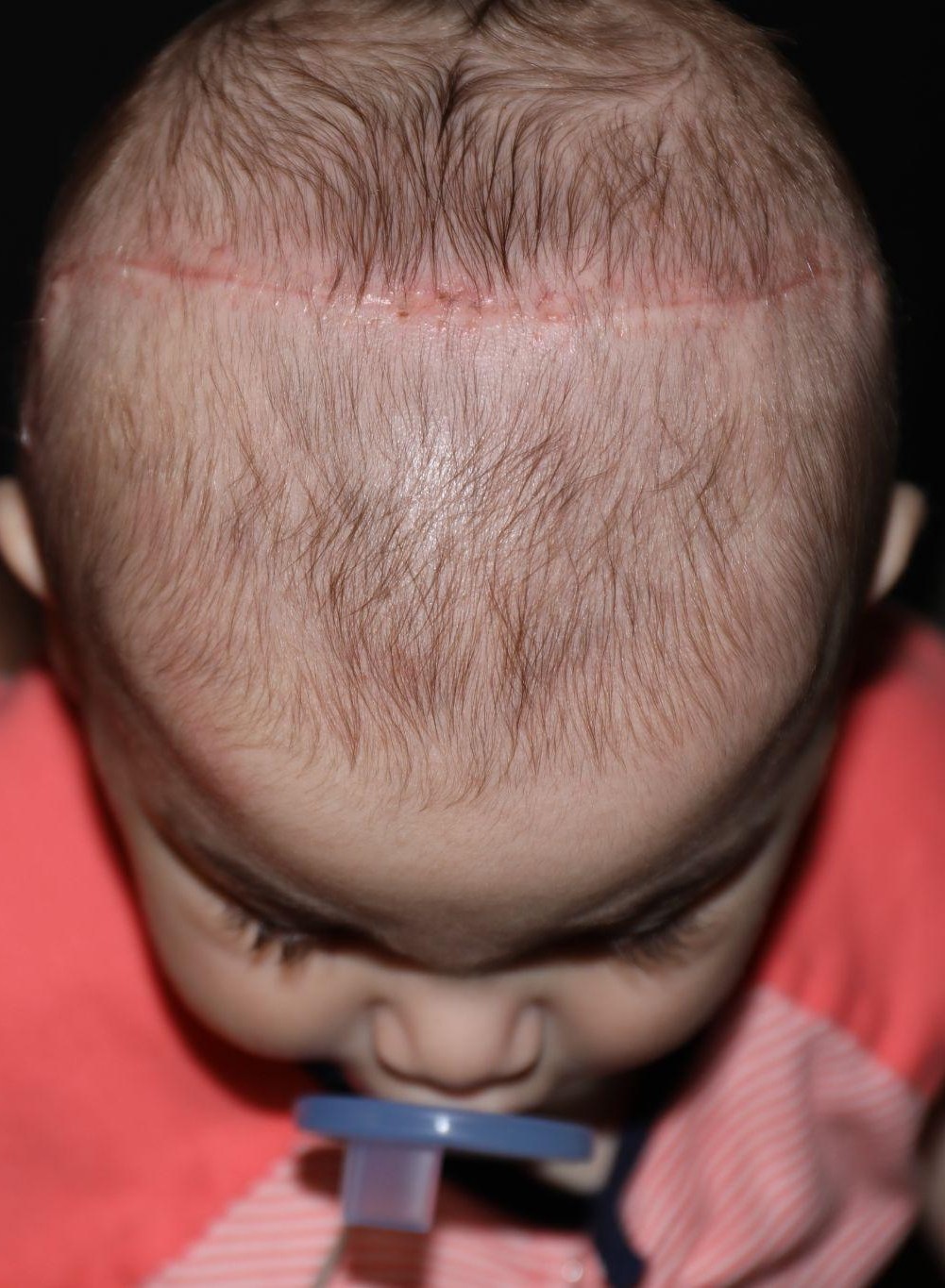 Top (vertex) at Year 2 after treatment - Case 1016