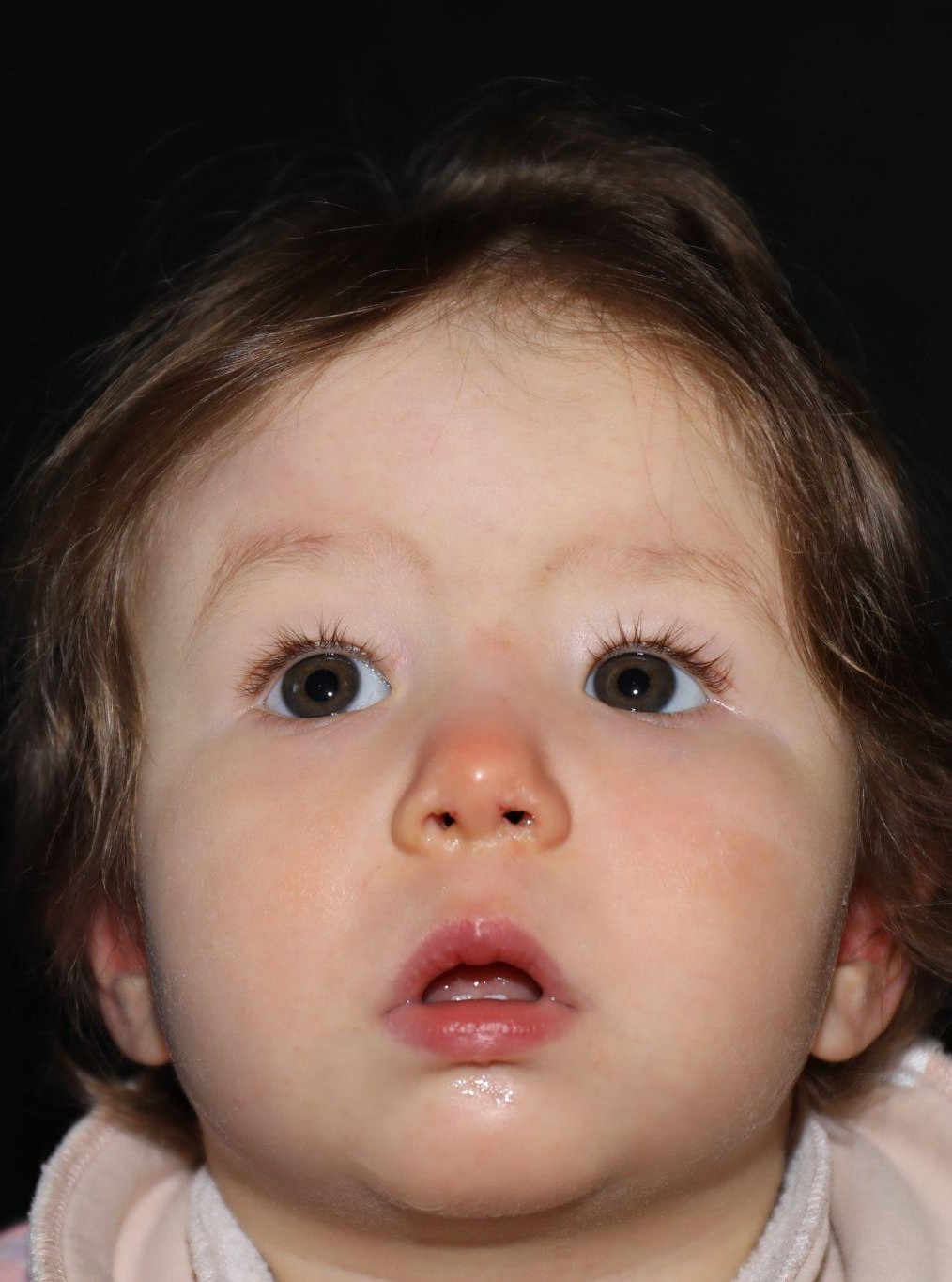 Chin at Year 2 after treatment - Case 1017