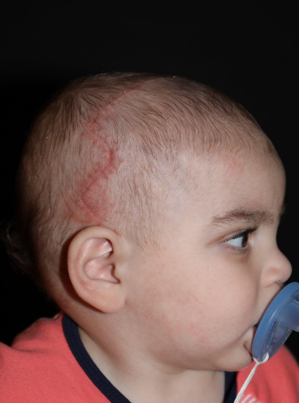 Right profile at Year 2 after treatment - Case 1016