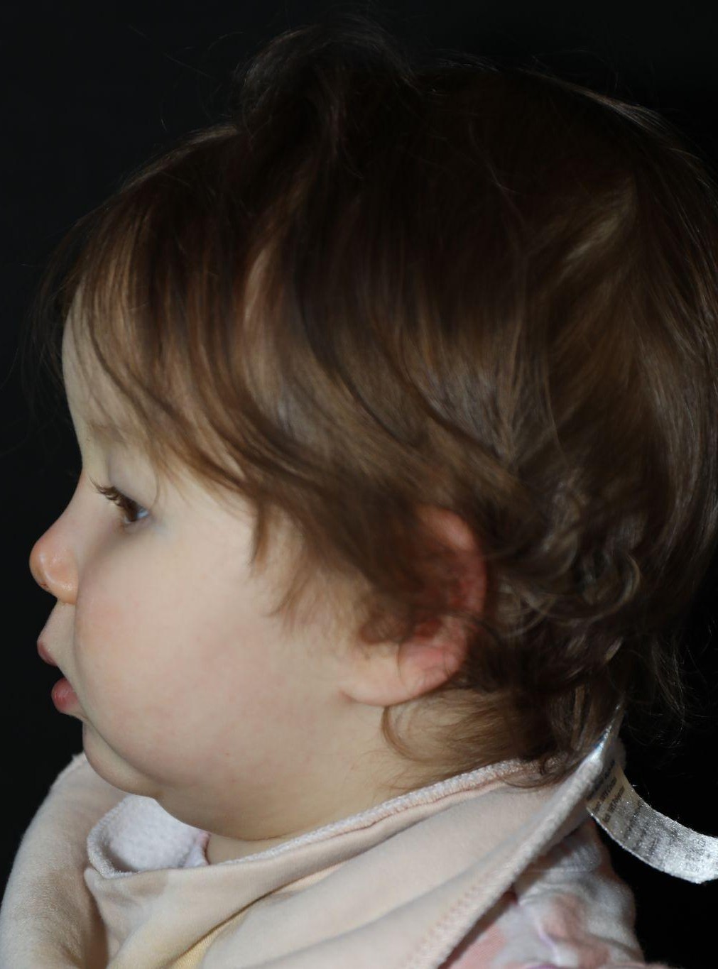 Left profile at Year 2 after treatment - Case 1017