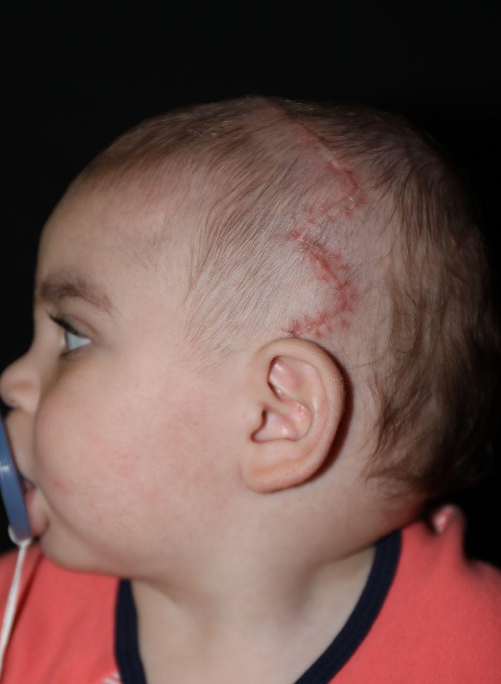Left profile at Year 2 after treatment - Case 1016