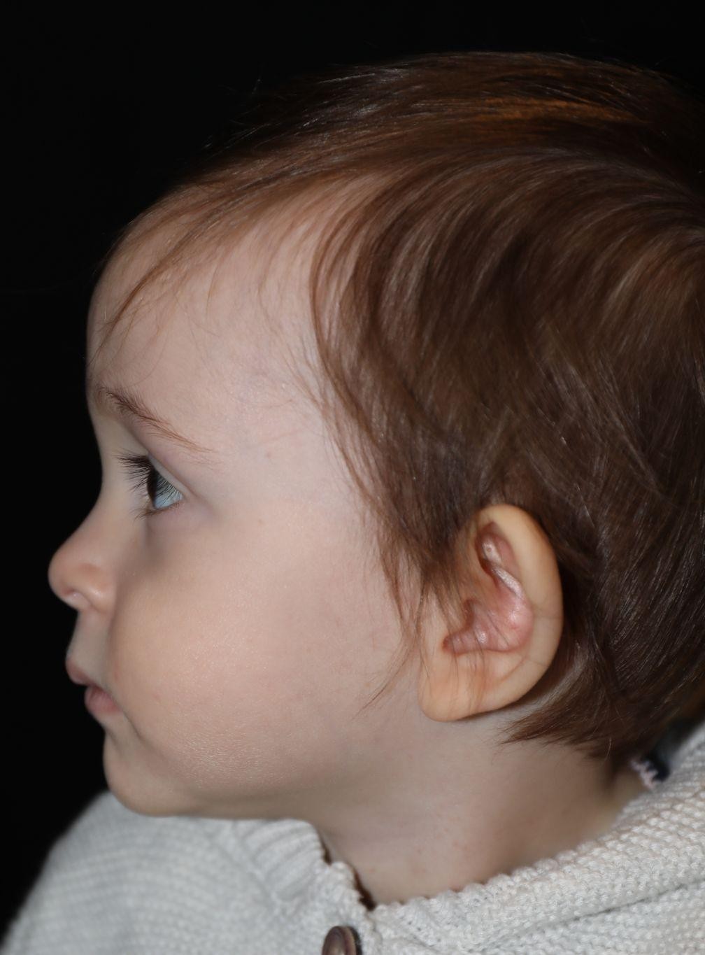 Left profile at Year 2 after treatment - Case 1020