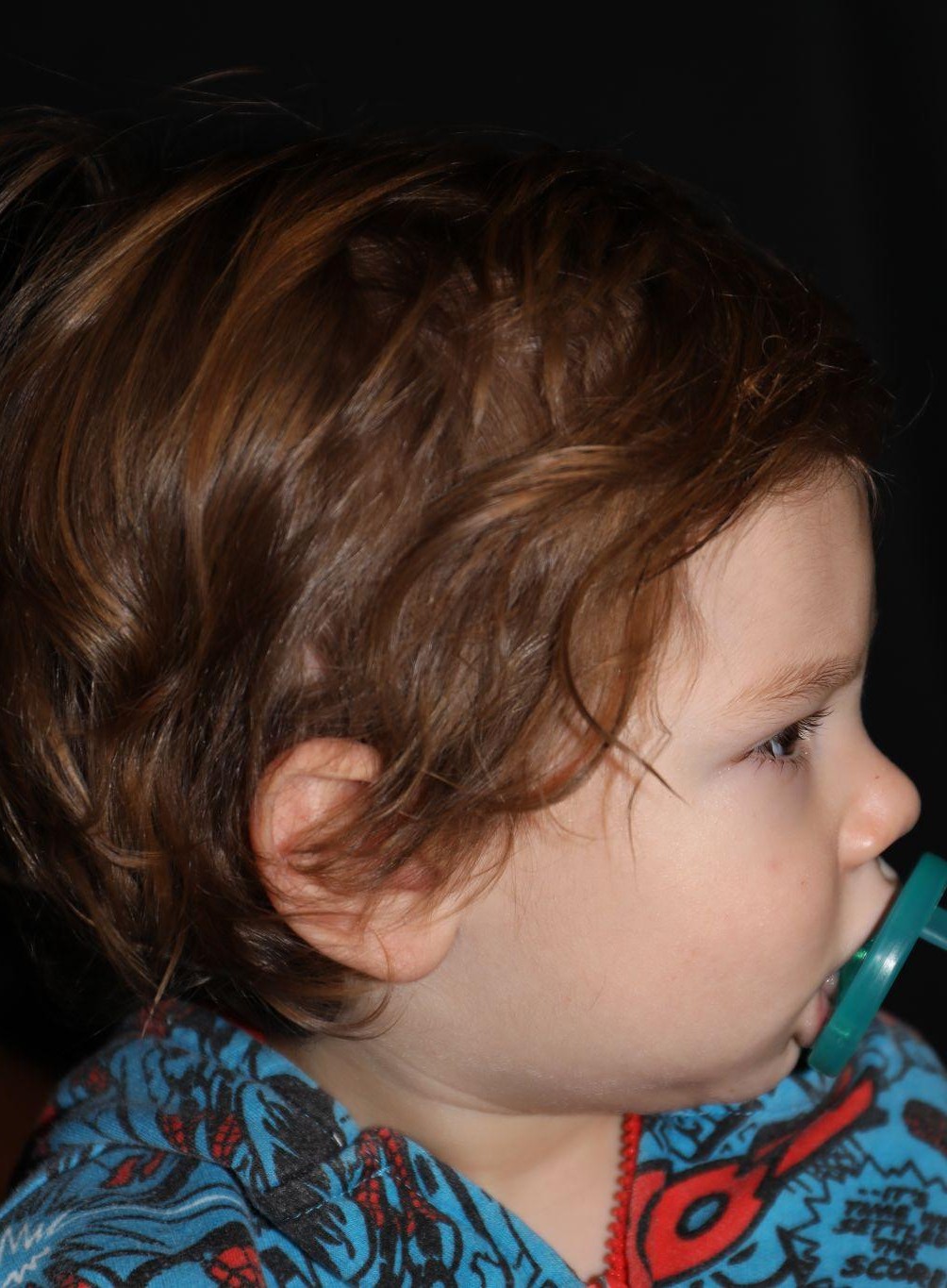 Right profile at Year 2 after treatment - Case 1013