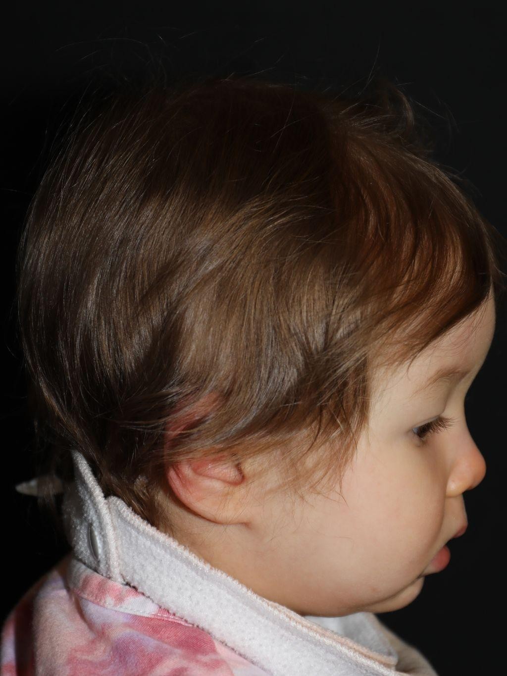 Right profile at Year 2 after treatment - Case 1017