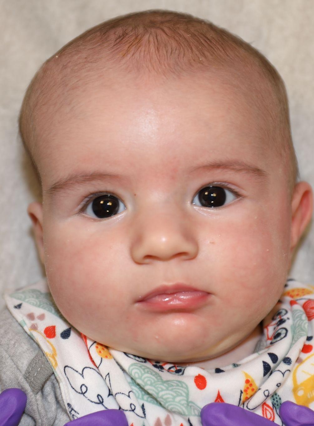 Front view at Year 3 after treatment - Case 5002