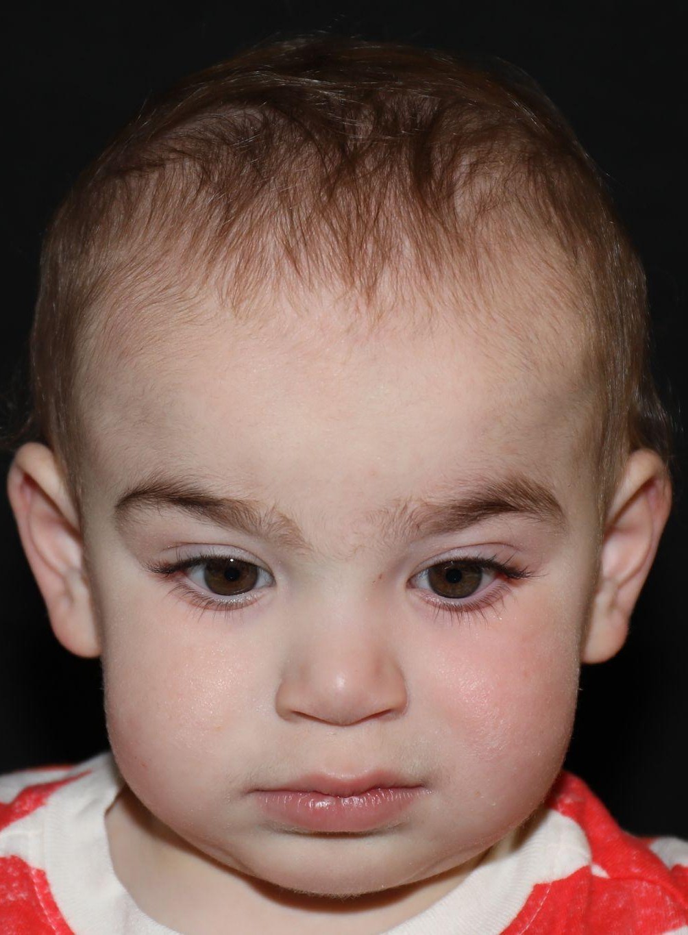 Front view at Year 3 after treatment - Case 1016