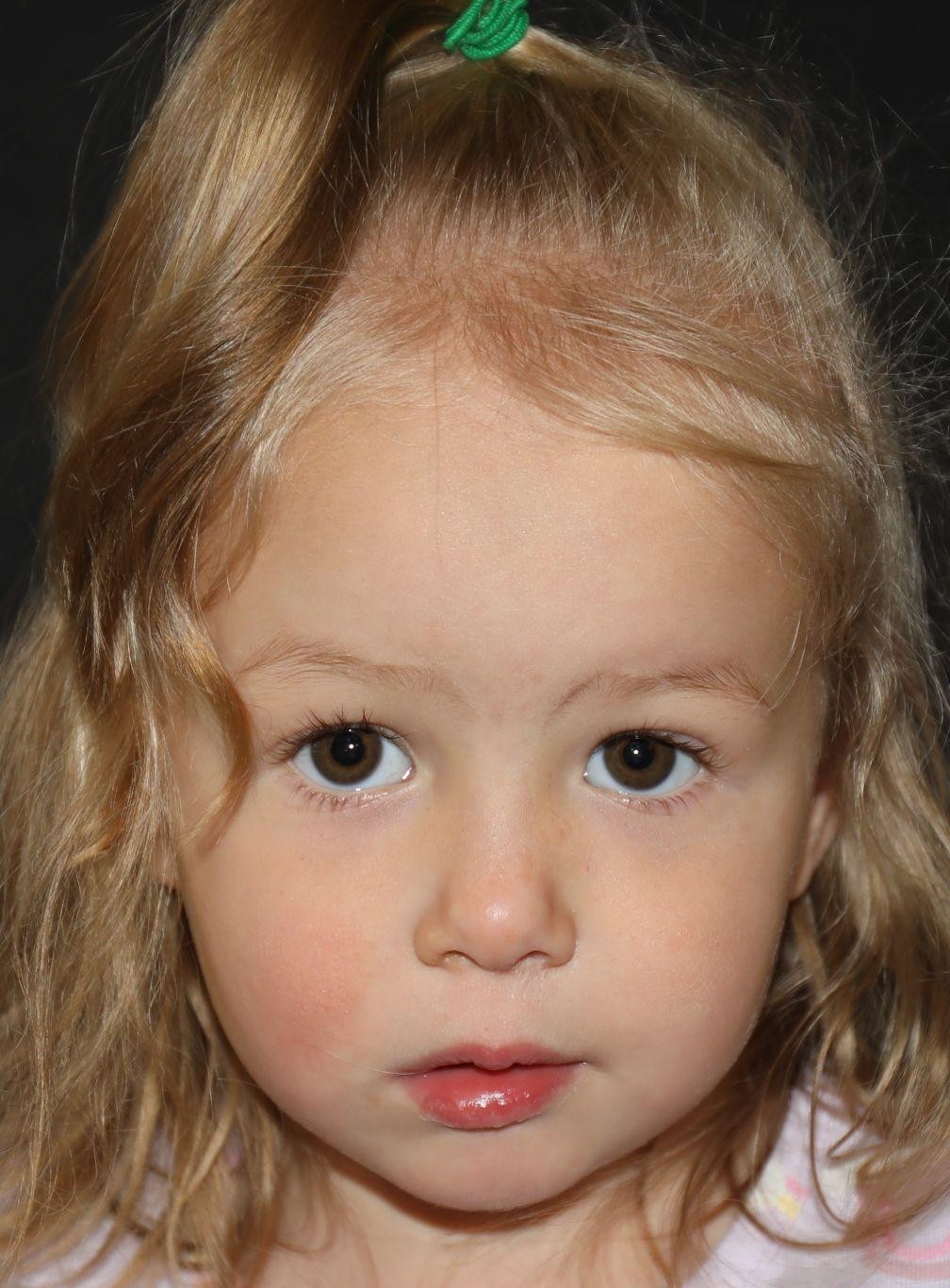 Front view at Year 3 after treatment - Case 1017