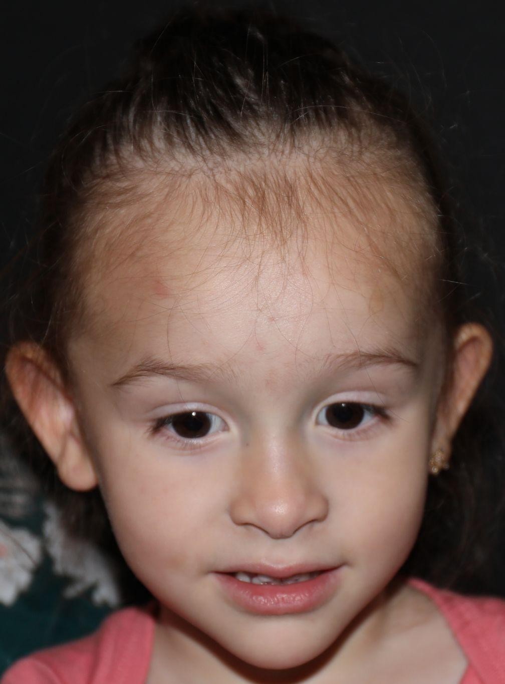 Front view at Year 3 after treatment - Case 1020