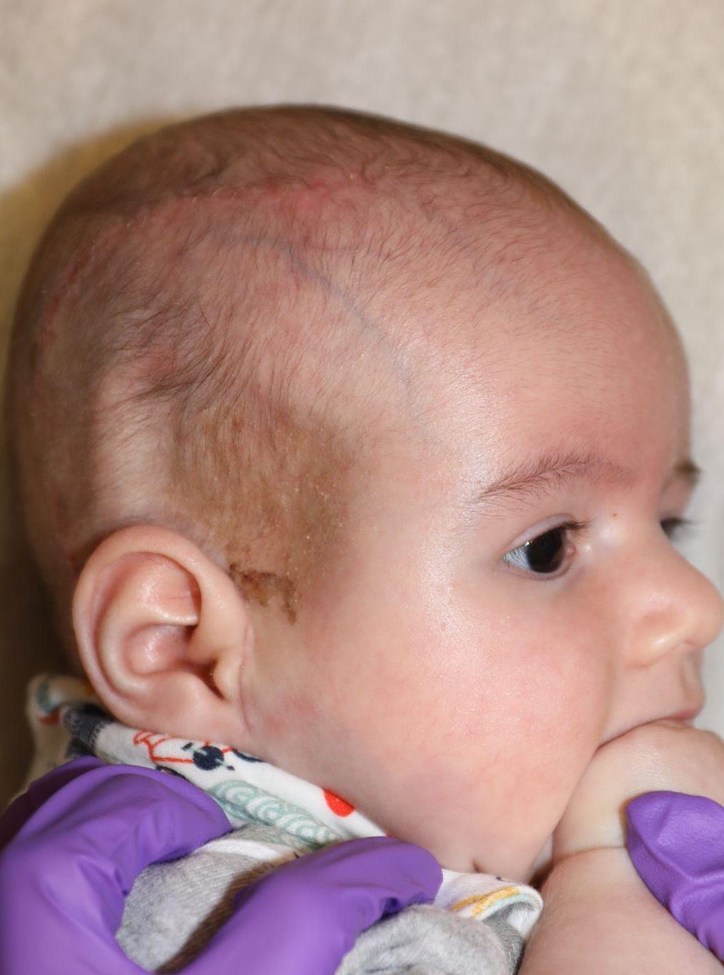 Right angle before treatment - Case 5002