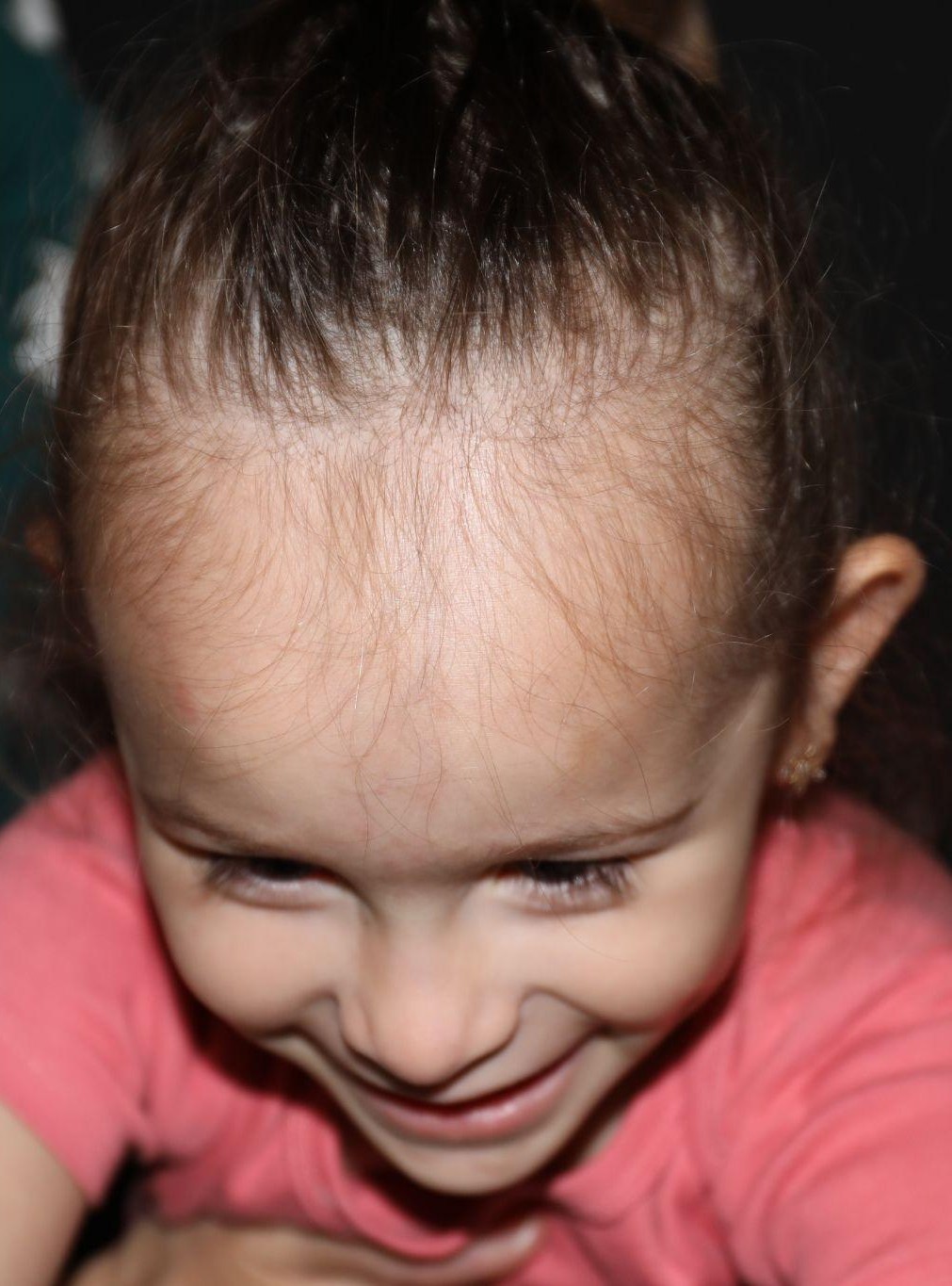 Top (vertex) at Year 3 after treatment - Case 1020