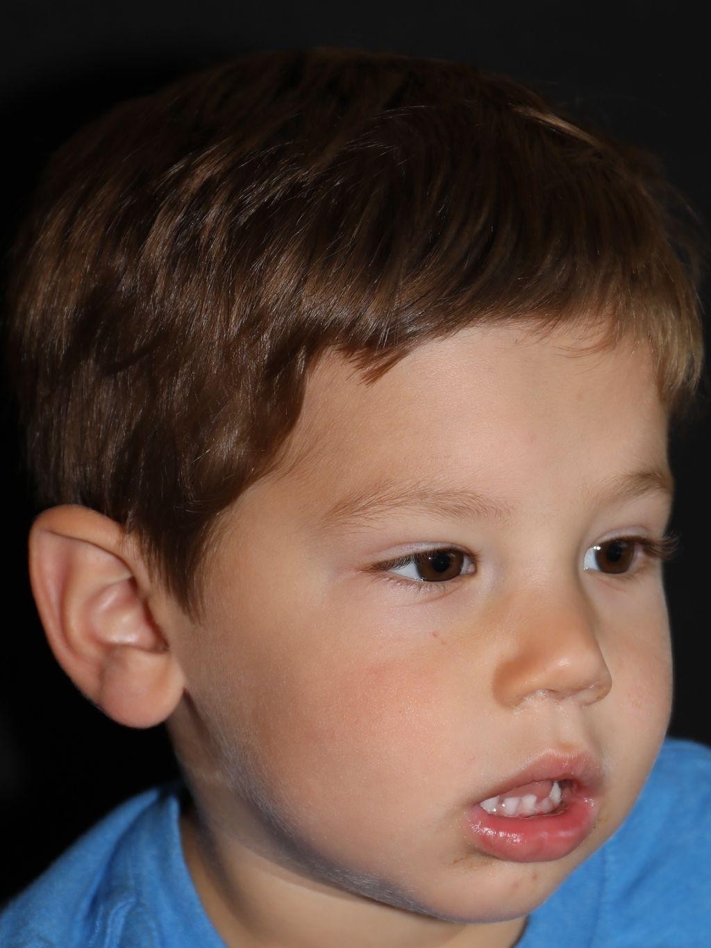 Right angle at Year 3 after treatment - Case 1013