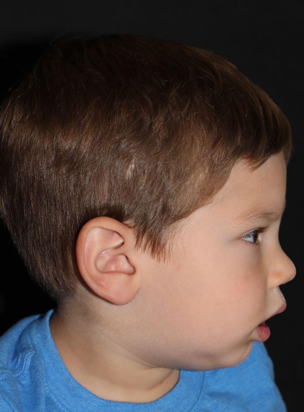 Right profile at Year 3 after treatment - Case 1013