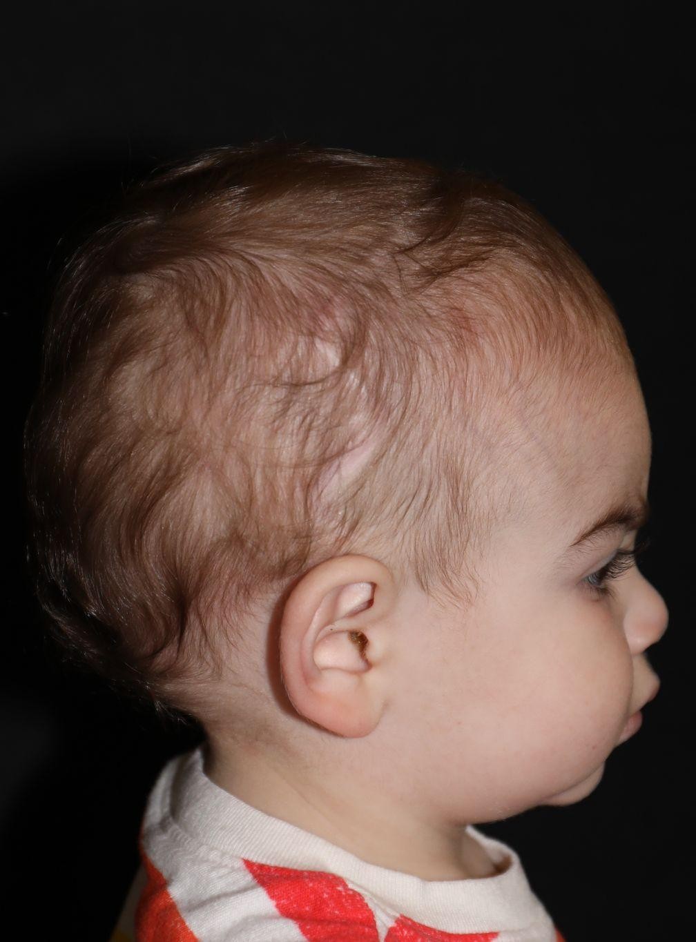 Right profile at Year 3 after treatment - Case 1016