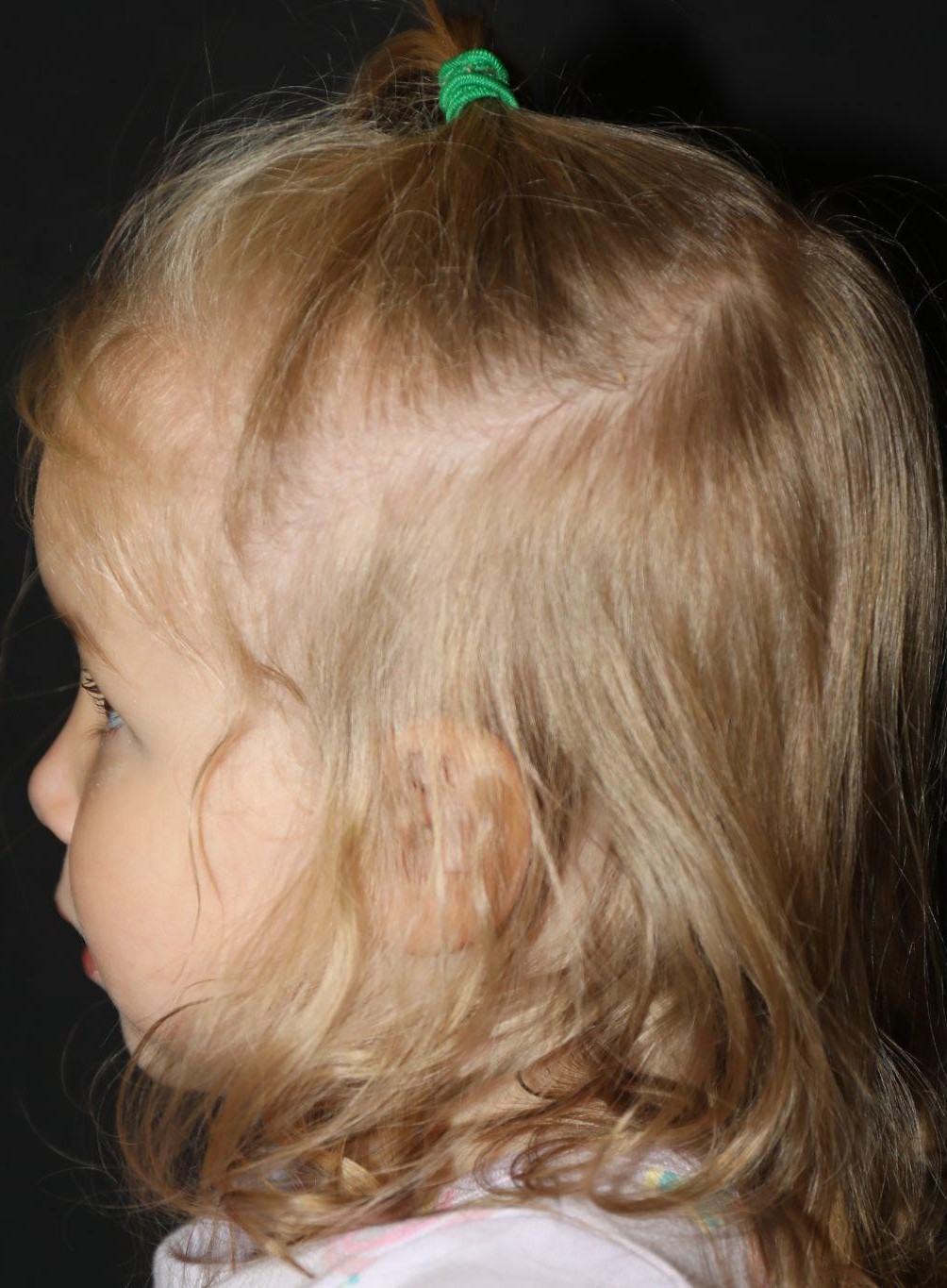 Left profile at Year 3 after treatment - Case 1017