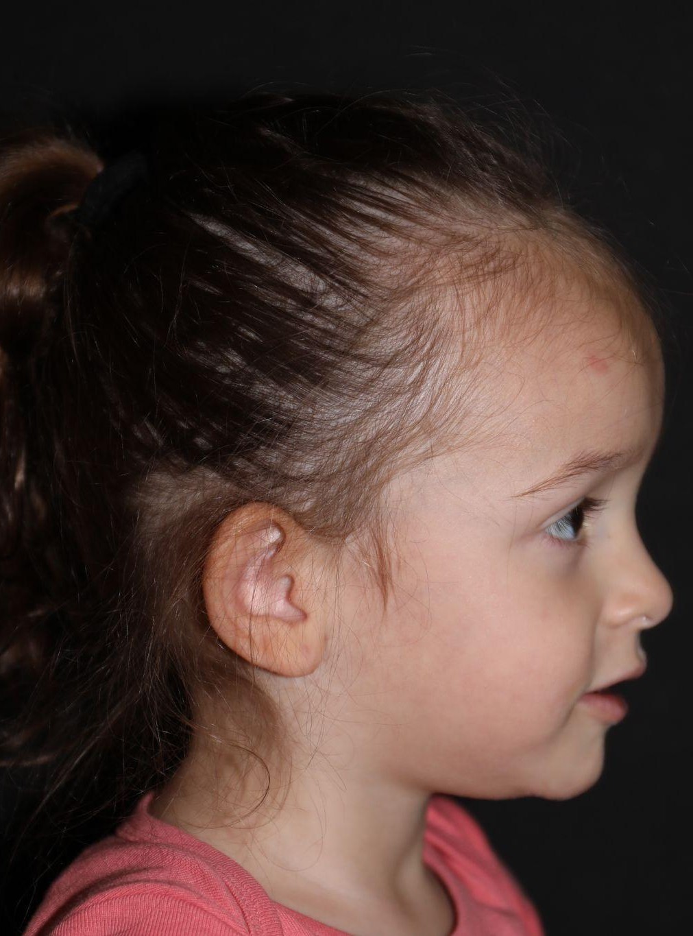Right profile at Year 3 after treatment - Case 1020