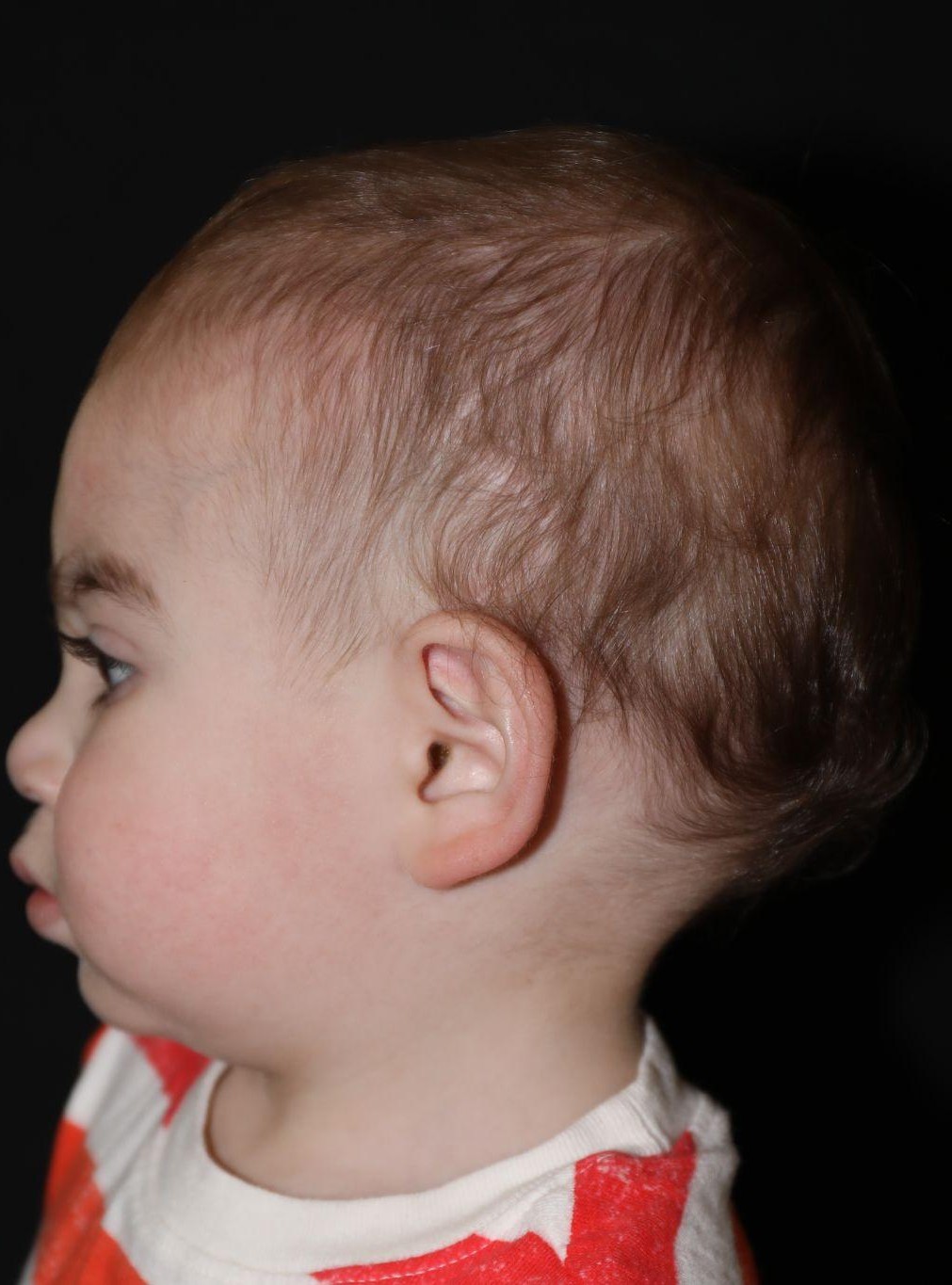 Left profile at Year 3 after treatment - Case 1016