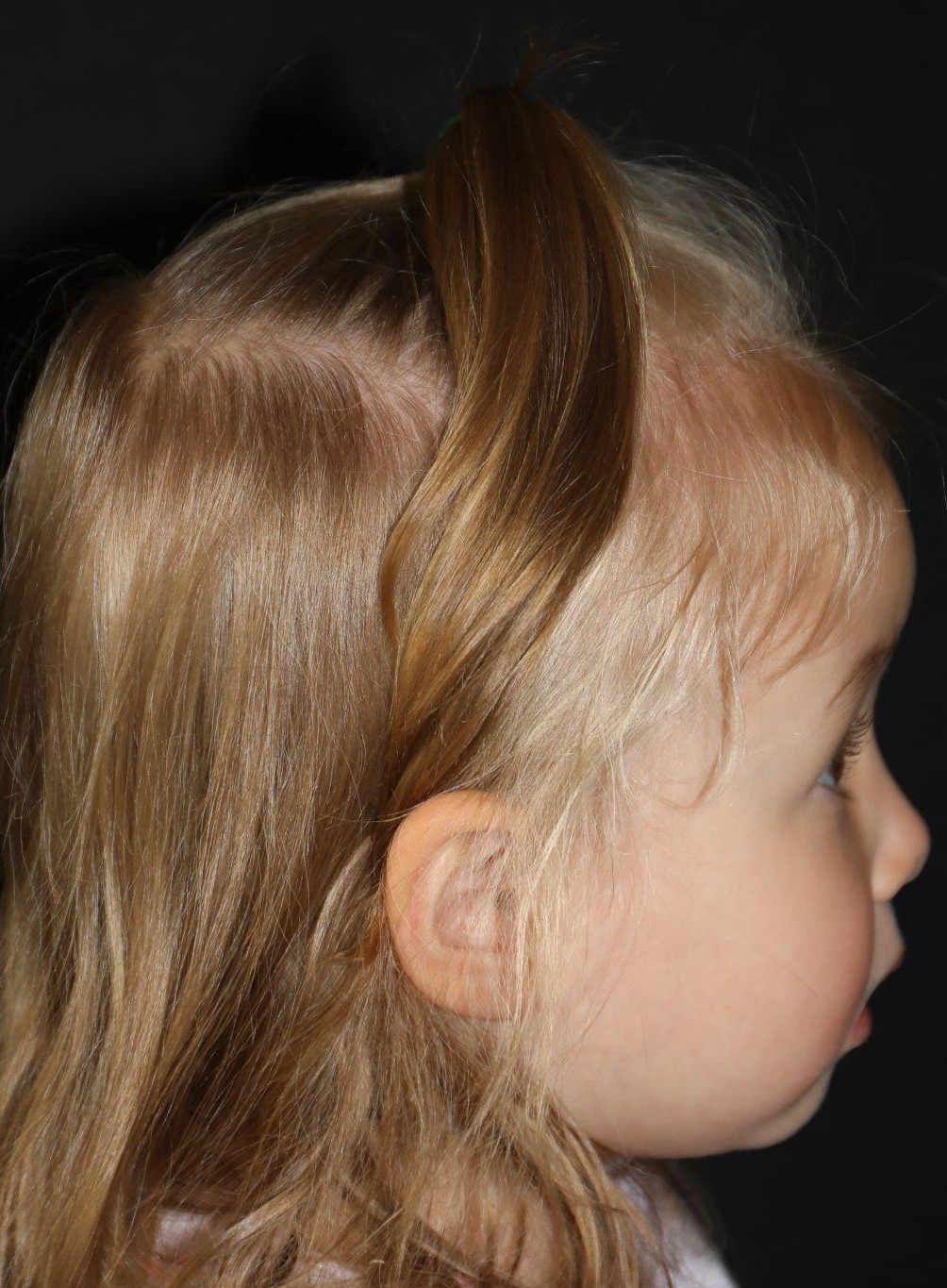 Right profile at Year 3 after treatment - Case 1017