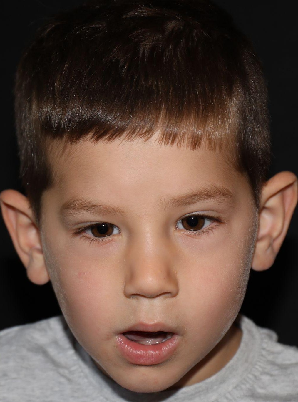 Front view at Year 4 after treatment - Case 1013