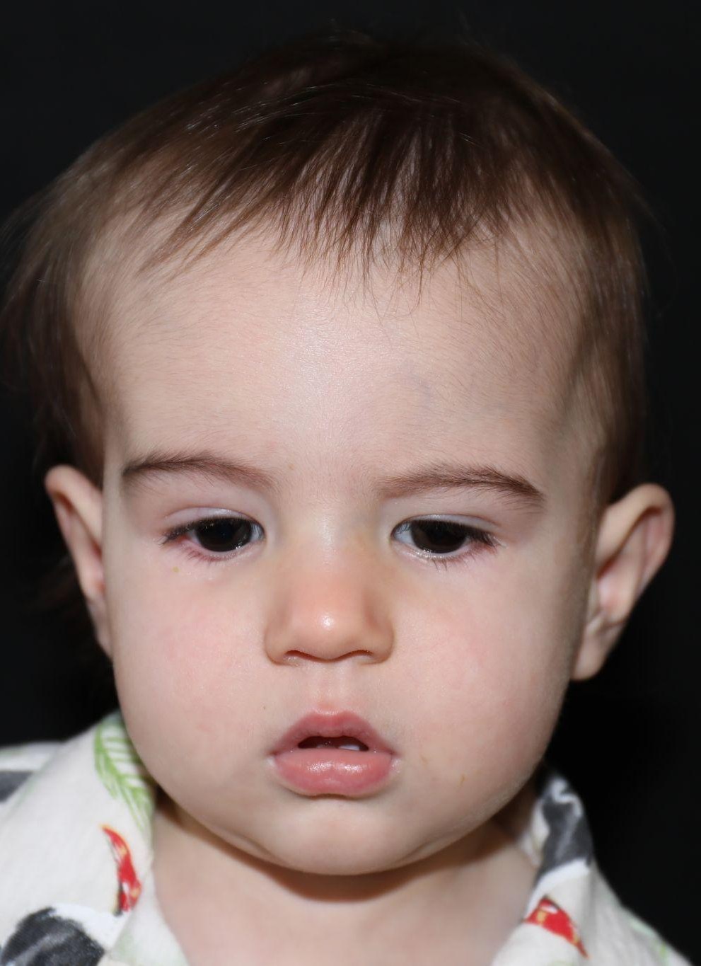 Front view at Year 4 after treatment - Case 5002