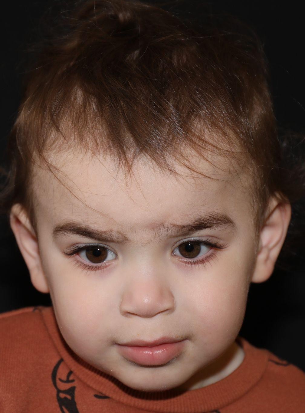 Front view at Year 4 after treatment - Case 1016