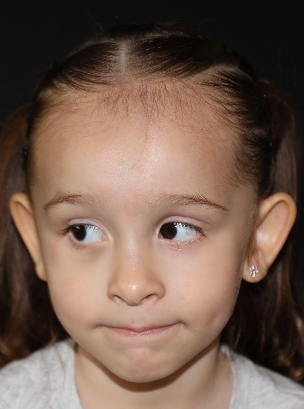 Front view at Year 4 after treatment - Case 1020