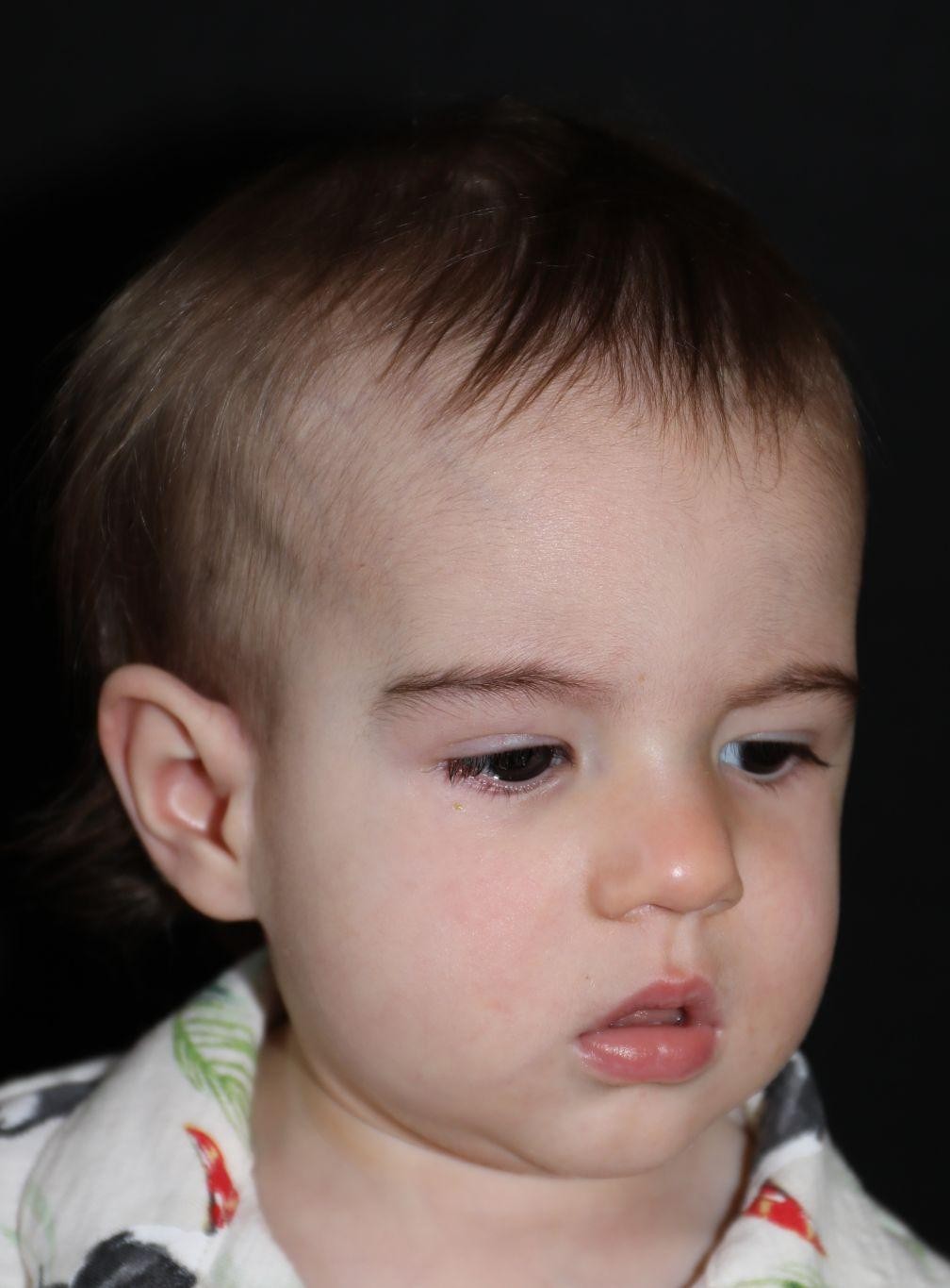 Right angle at Year 4 after treatment - Case 5002