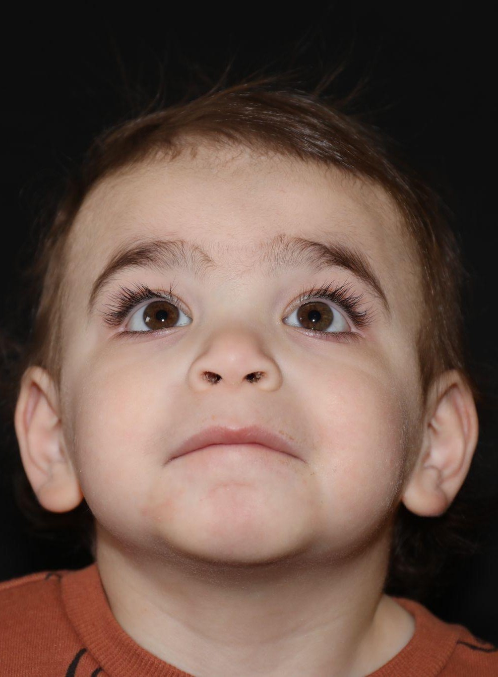 Chin before treatment - Case 1016