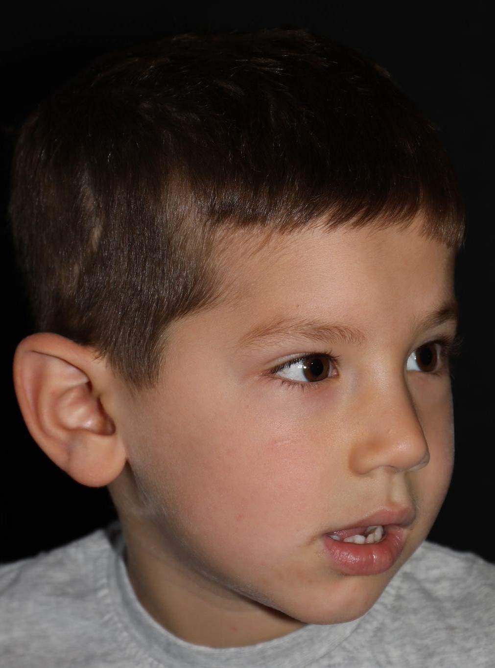Right angle at Year 4 after treatment - Case 1013