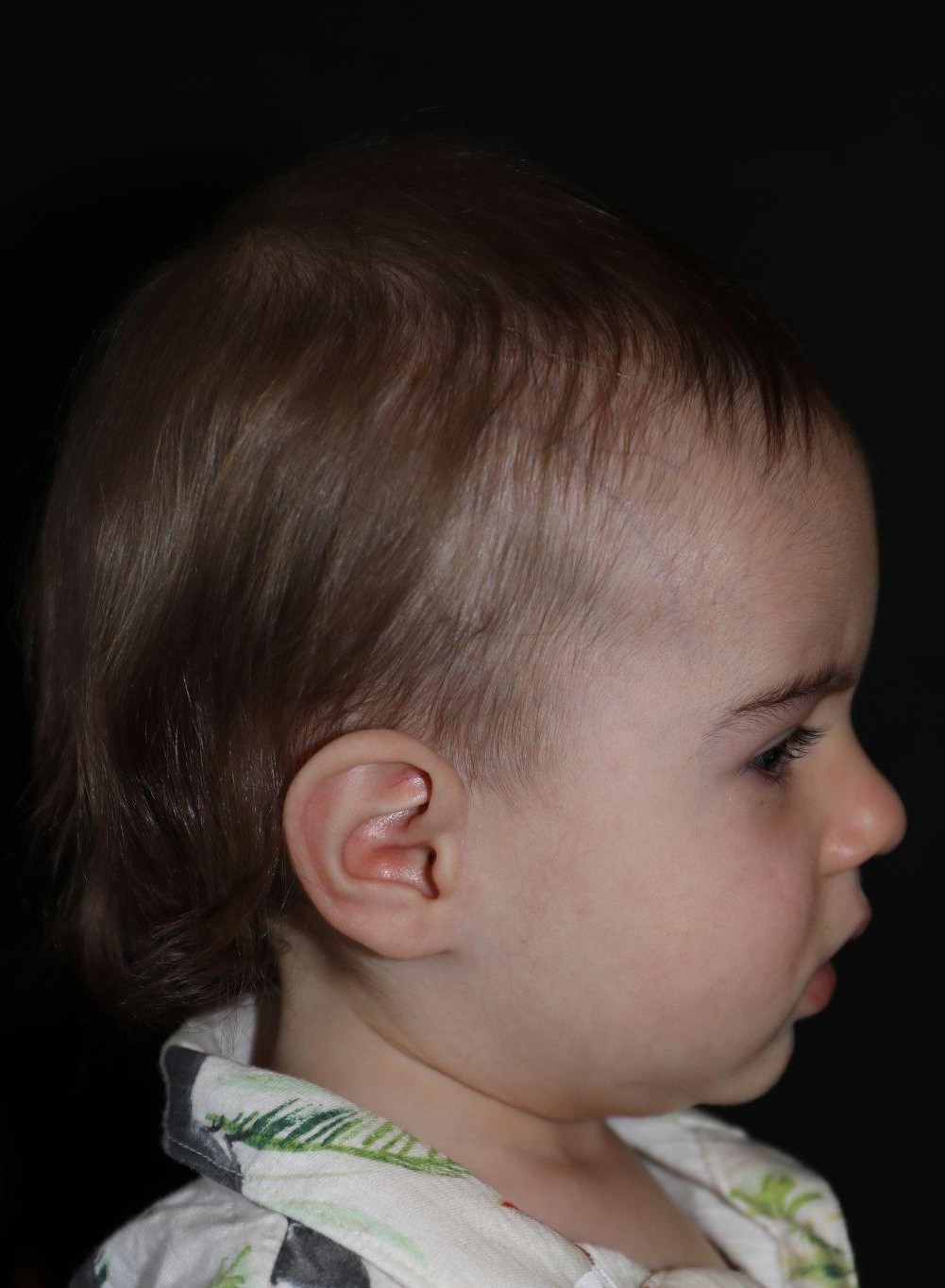 Right profile before treatment - Case 5002