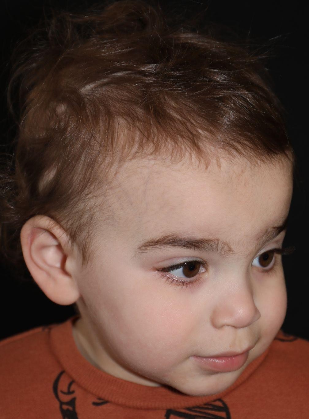 Right angle at Year 4 after treatment - Case 1016