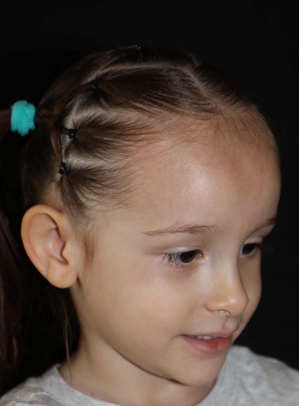 Right angle at Year 4 after treatment - Case 1020