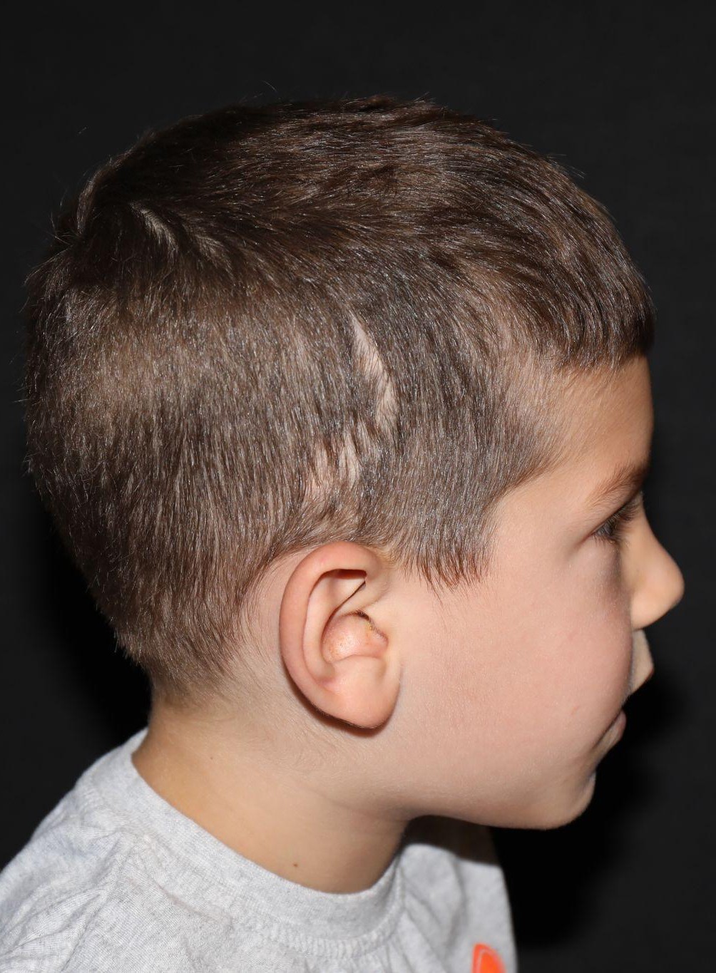 Right profile at Year 4 after treatment - Case 1013